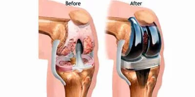 Knee Replacement Surgery