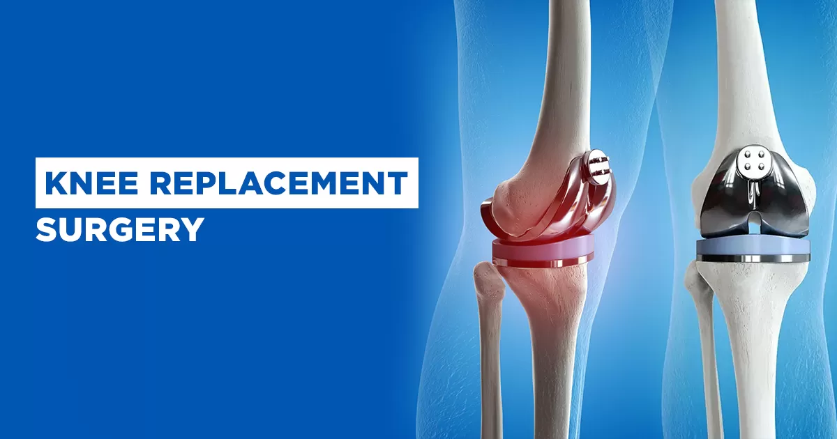 Knee Replacement Surgery Cost in Hyderabad