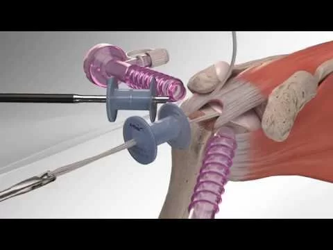 Shoulder Surgery