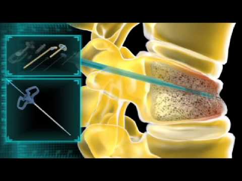 Spine Treatment 3