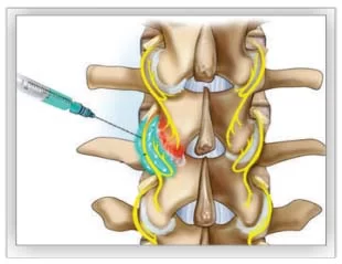 Spine Treatment 4